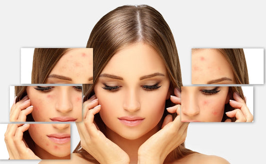 Affordable and Effective: Easy Tips to Remove Acne at Home - Fytika Healthcare Products