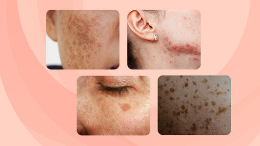 Winning the Battle Against Hyperpigmentation: Your Ultimate Guide - Fytika Healthcare Products