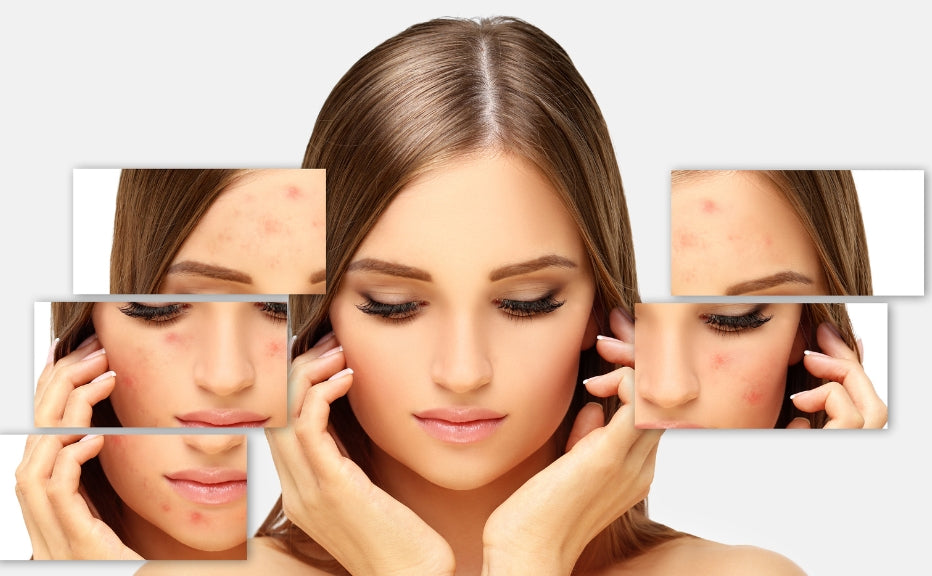 Affordable and Effective: Easy Tips to Remove Acne at Home - Fytika Healthcare Products