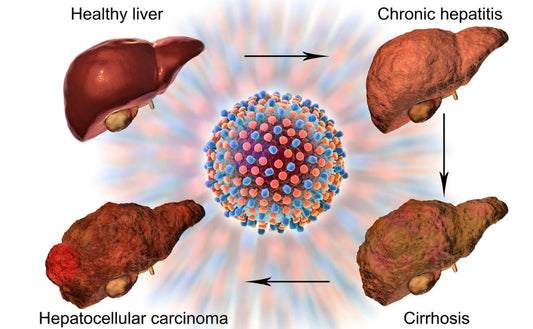 Fatty Liver: The silent epidemic you need to know about - Fytika Healthcare Products