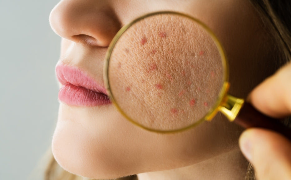 The importance of proper hygiene in preventing fungal acne breakouts